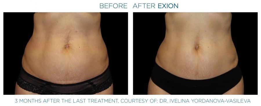 Before and after Exion Body contouring results.