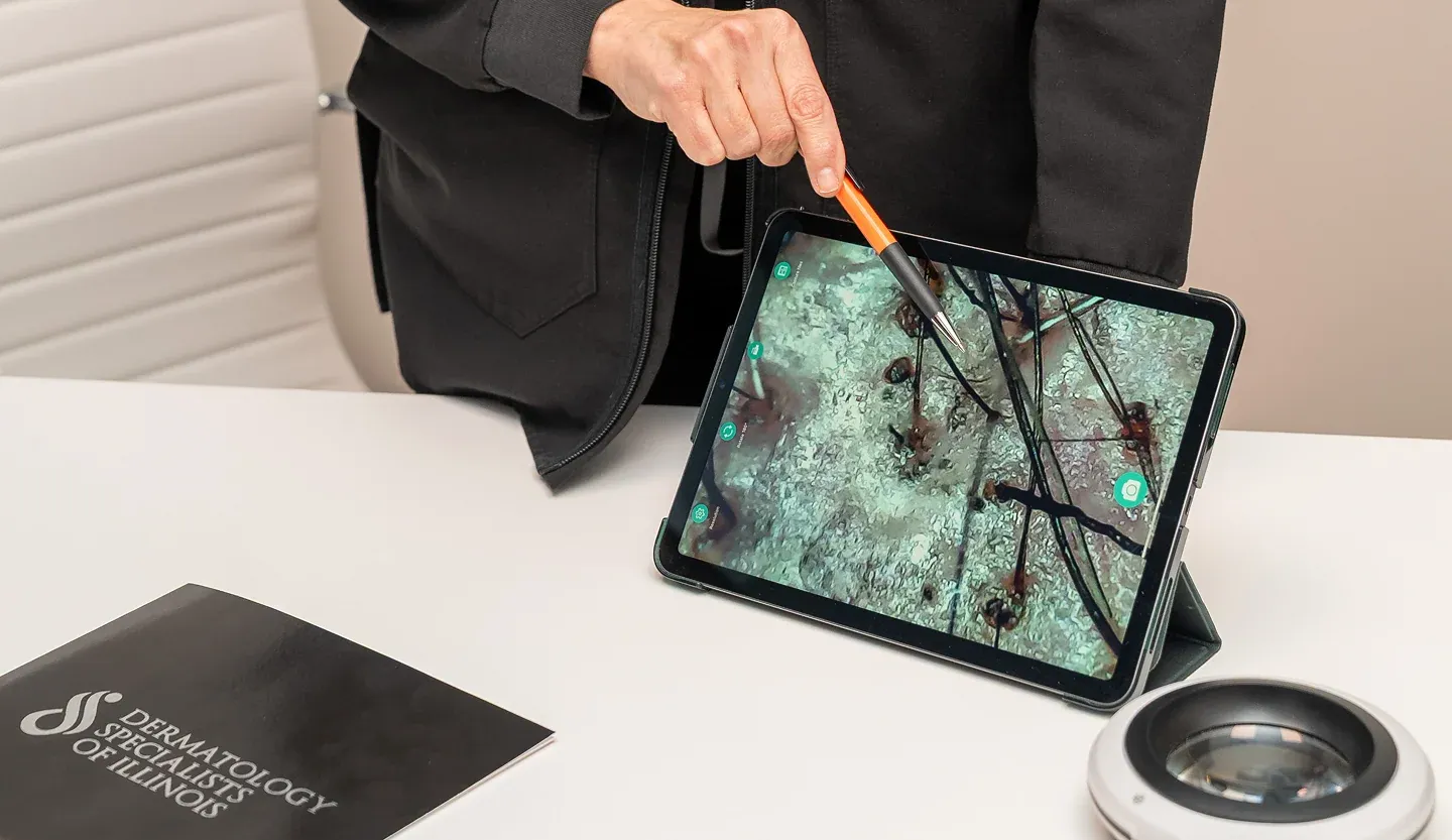 Before and after comparison showing FUE vs FUT hair transplant results