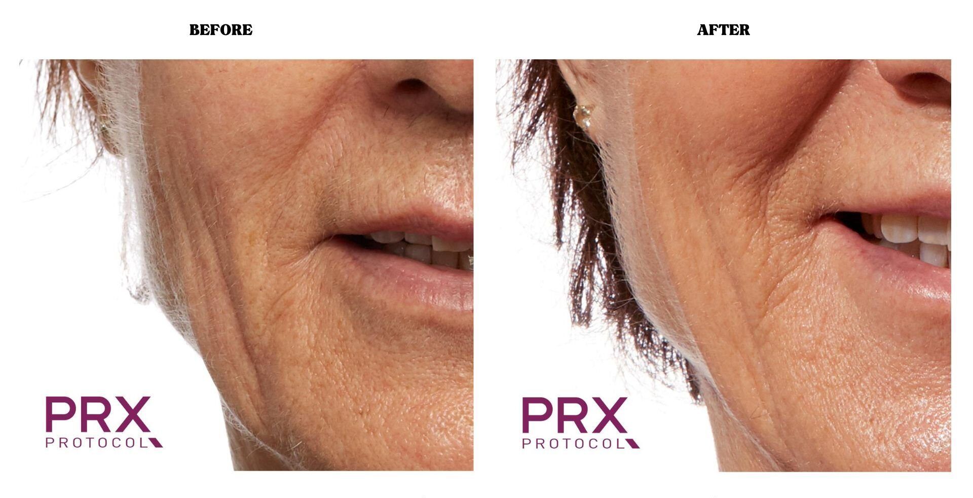 PRX - Before and After