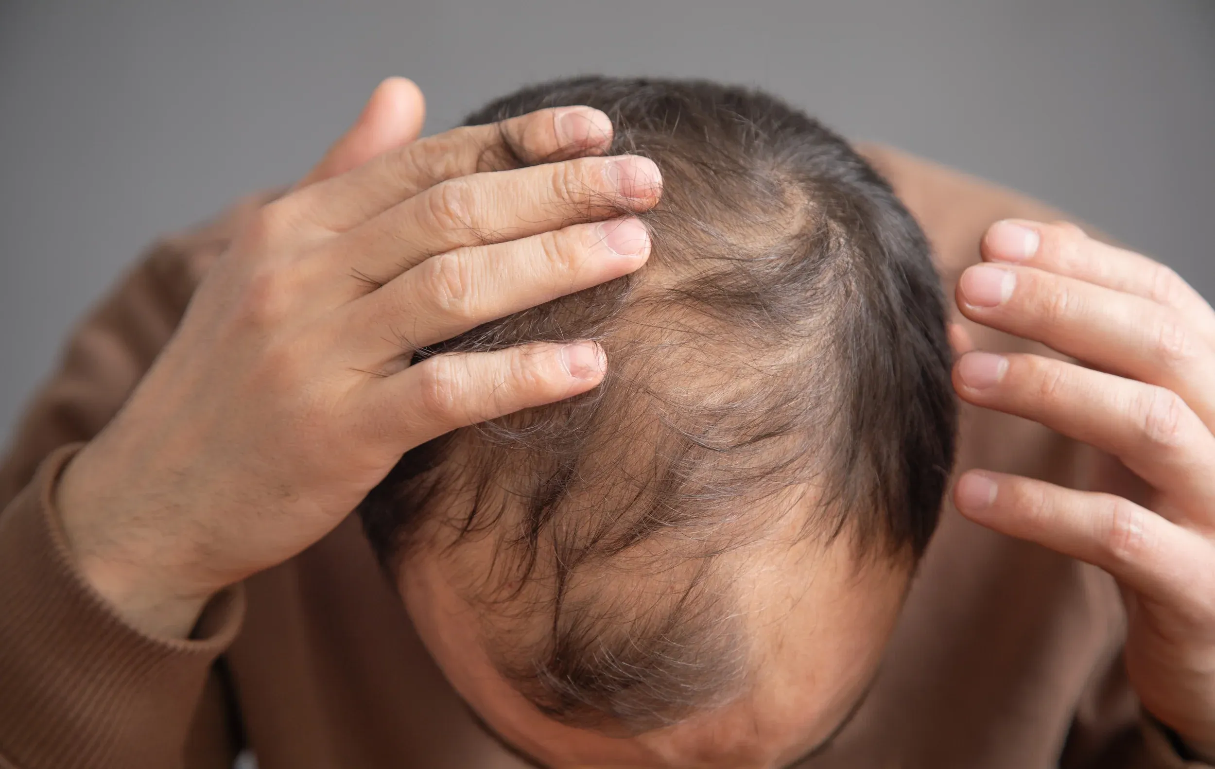 Close-up of person examining thinning hair on crown of head - understanding hair loss causes and patterns