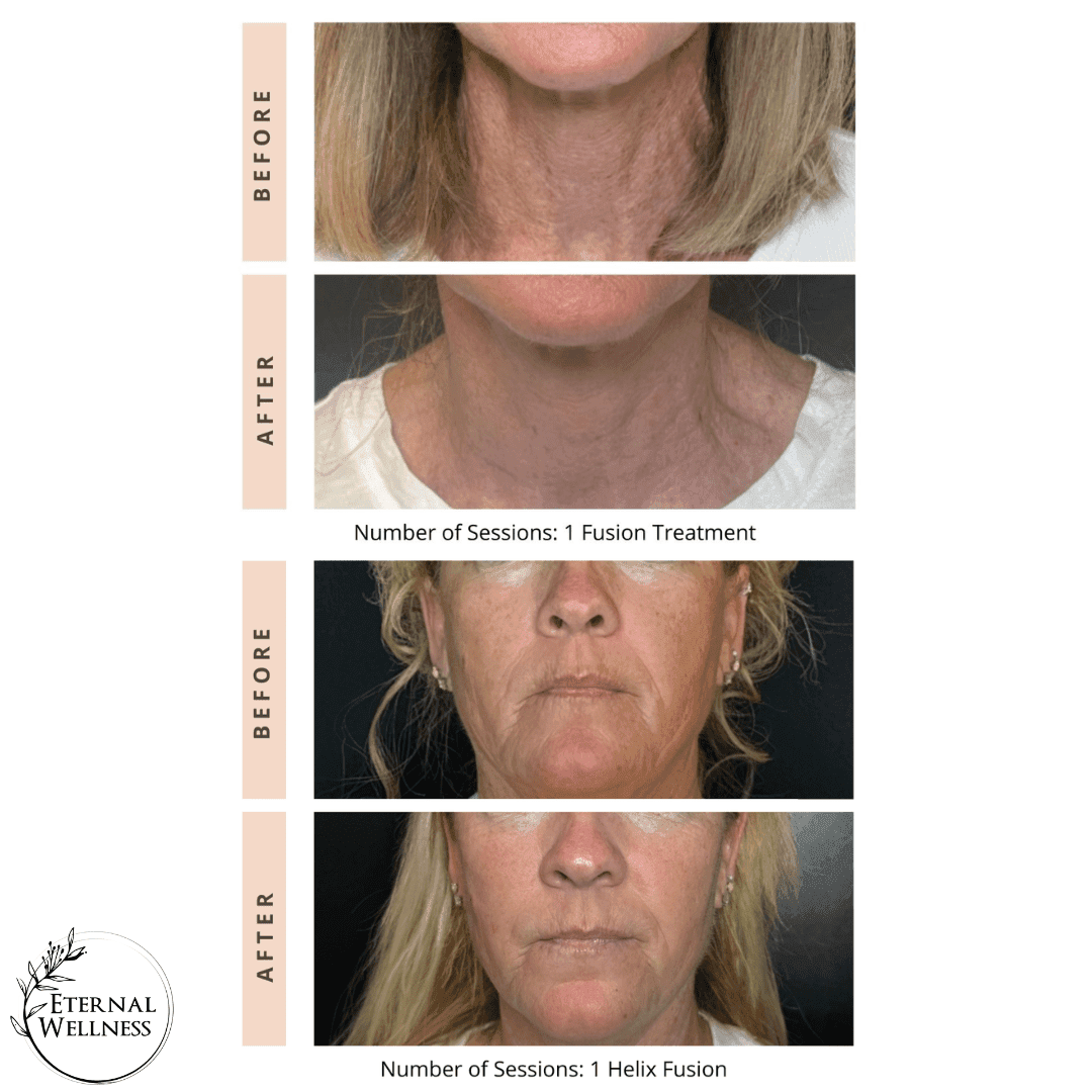 Helix CO2 Laser before and after