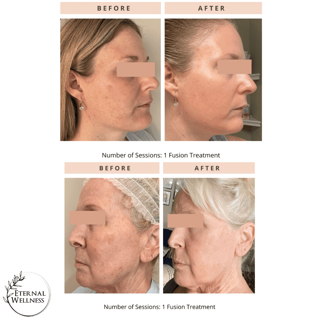 Helix CO2 before and after