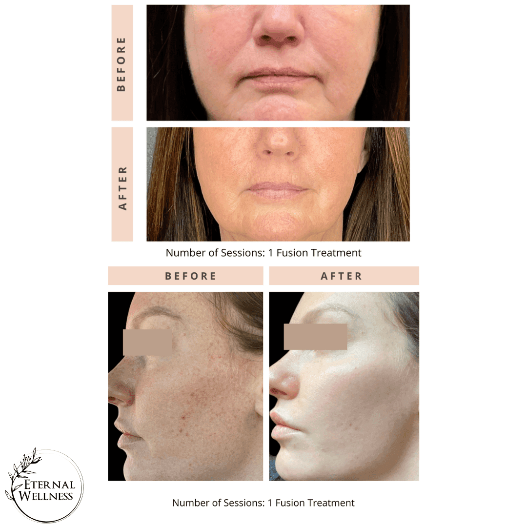 Helix CO2 before and after