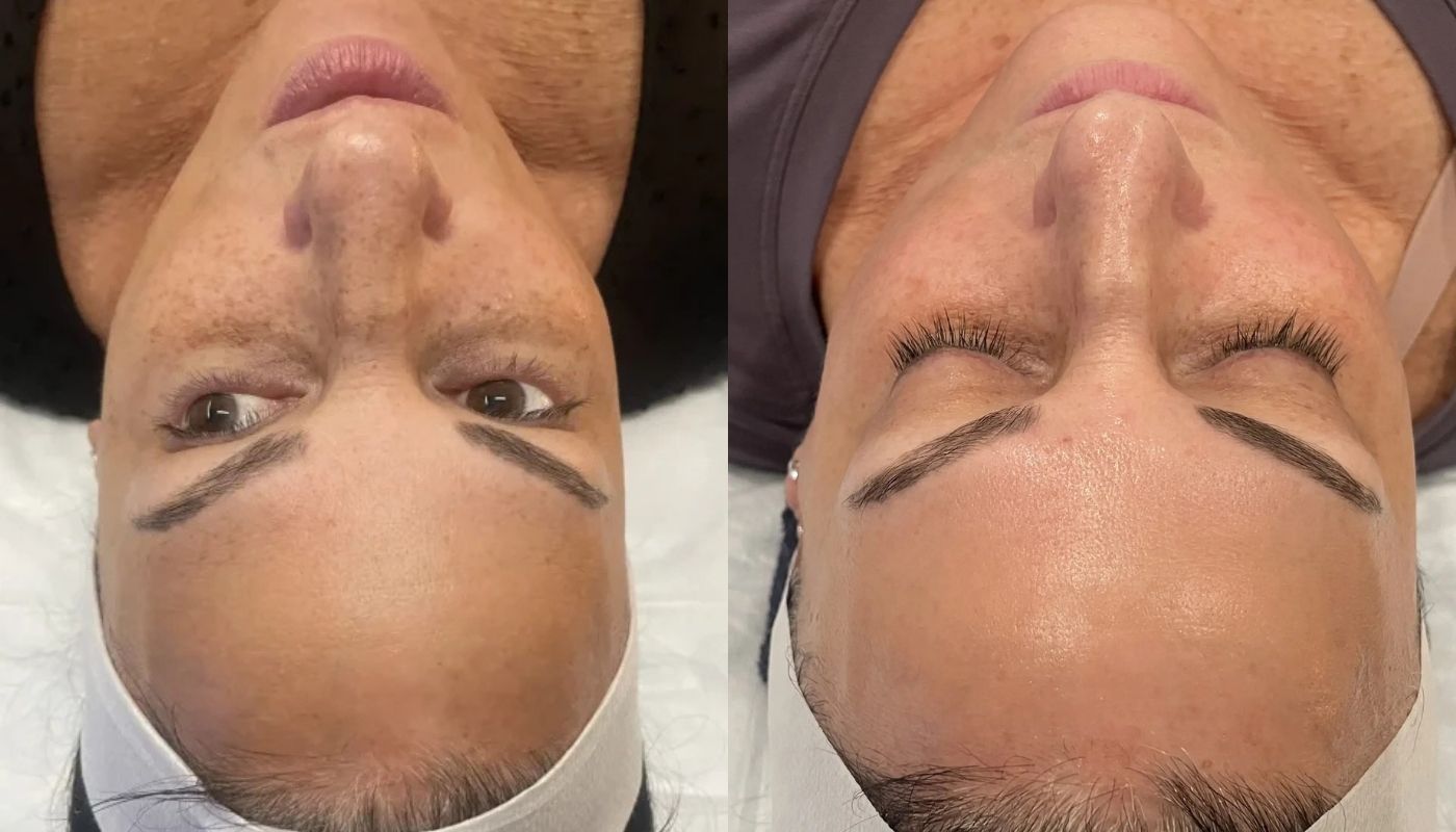 HydraFacial before and after