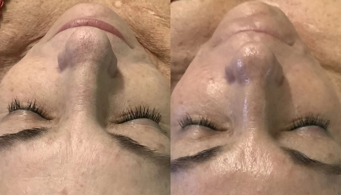 HydraFacial before and after