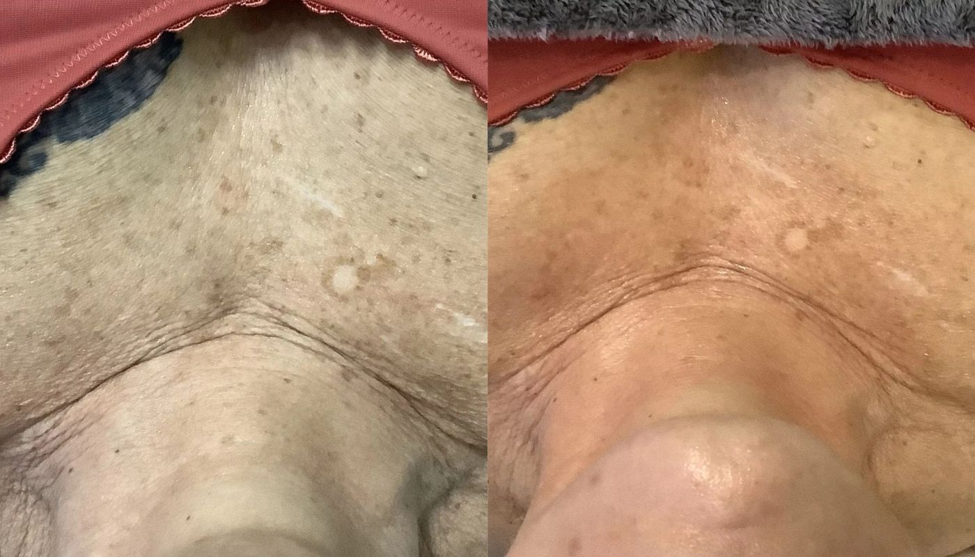 HydraFacial before and after