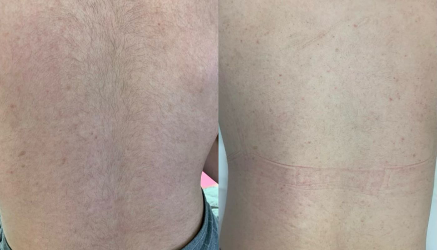 Laser Hair Removal GentleMax Pro | Boston, MA before and after