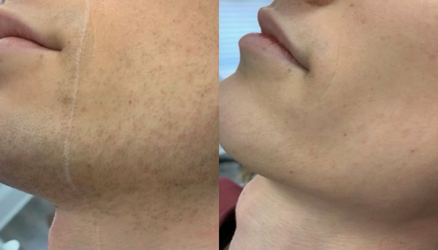 Laser Hair Removal GentleMax Pro | Boston, MA before and after