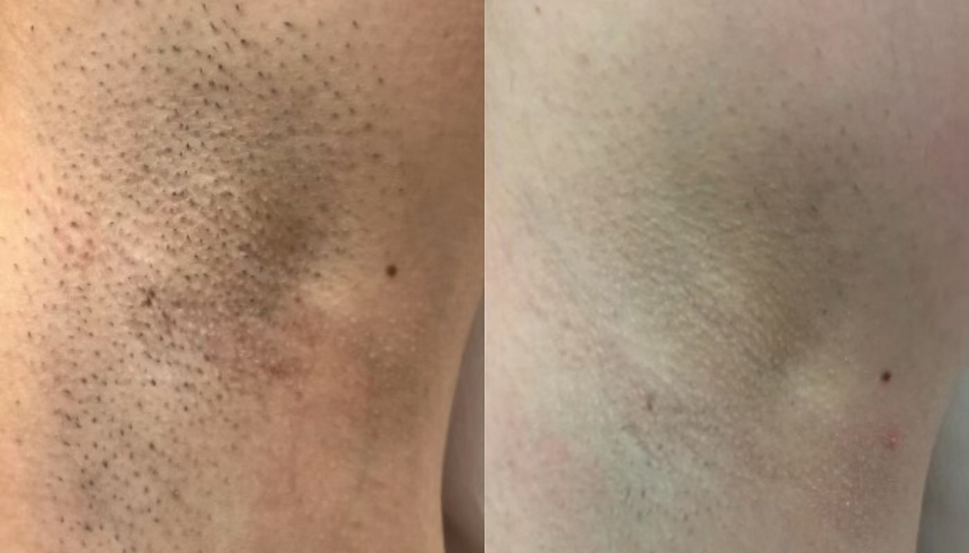 Laser Hair Removal GentleMax Pro | Boston, MA before and after