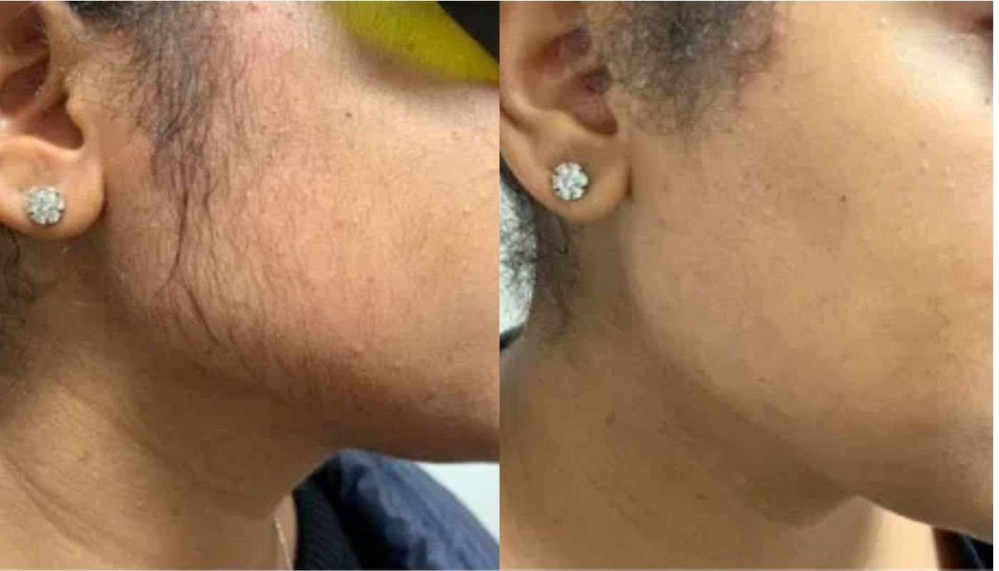 Laser Hair Removal Elite iQ | Cambridge, MA before and after
