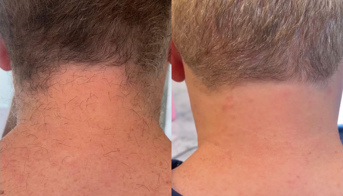 GentleMax Pro before and after