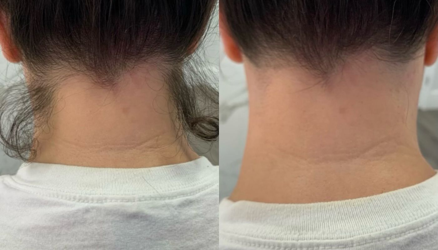 Laser Hair Removal GentleMax Pro | Boston, MA before and after