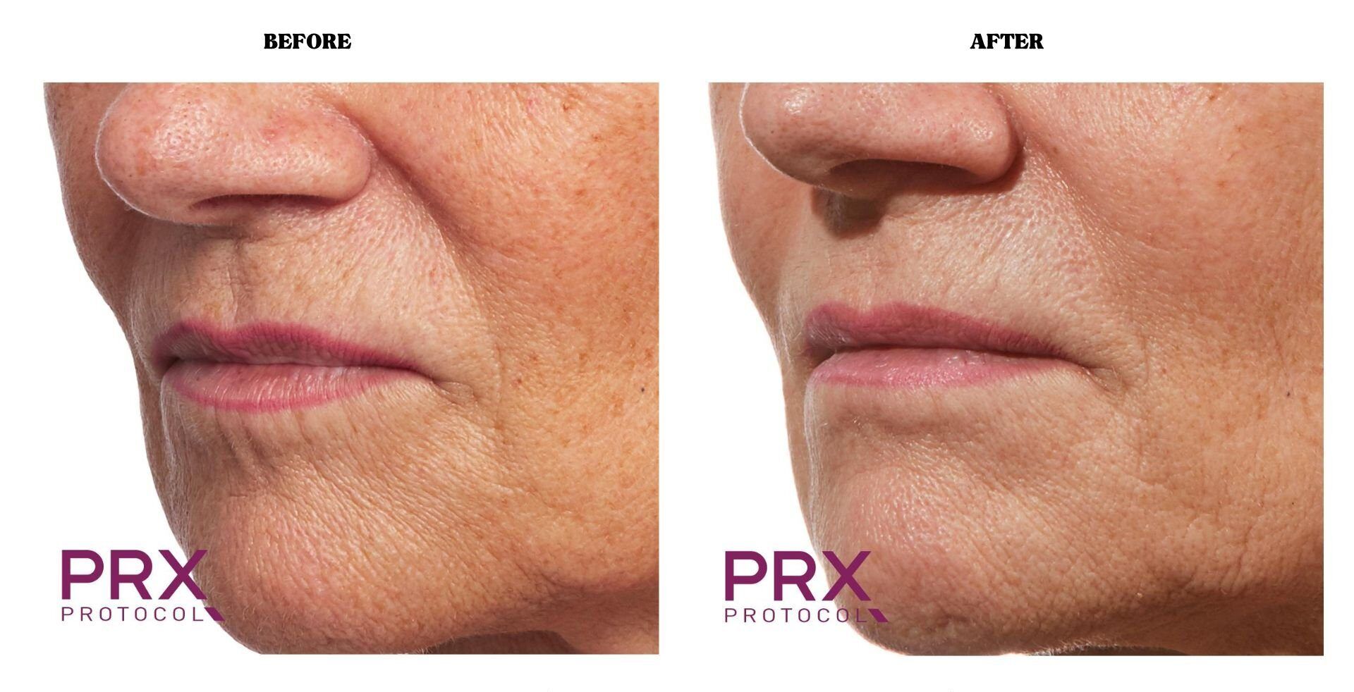 PRX - Before and After