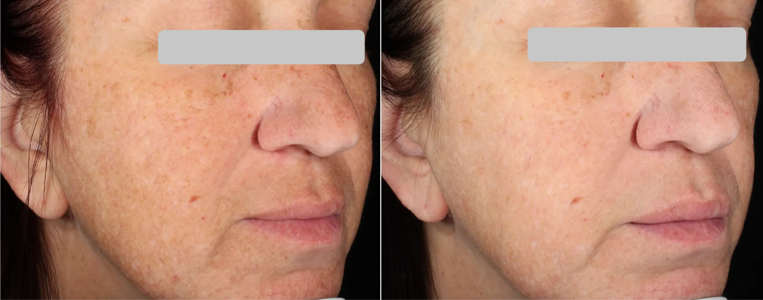 Matrix effect on the face