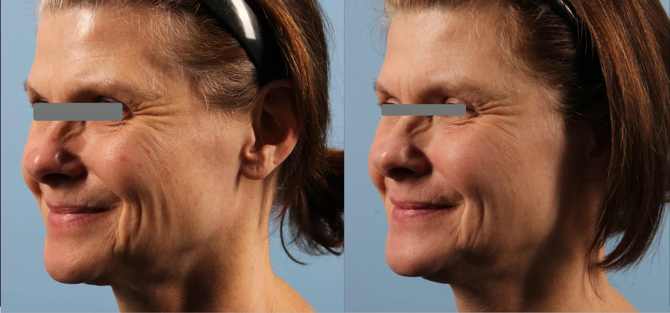 Matrix effect on cheeks