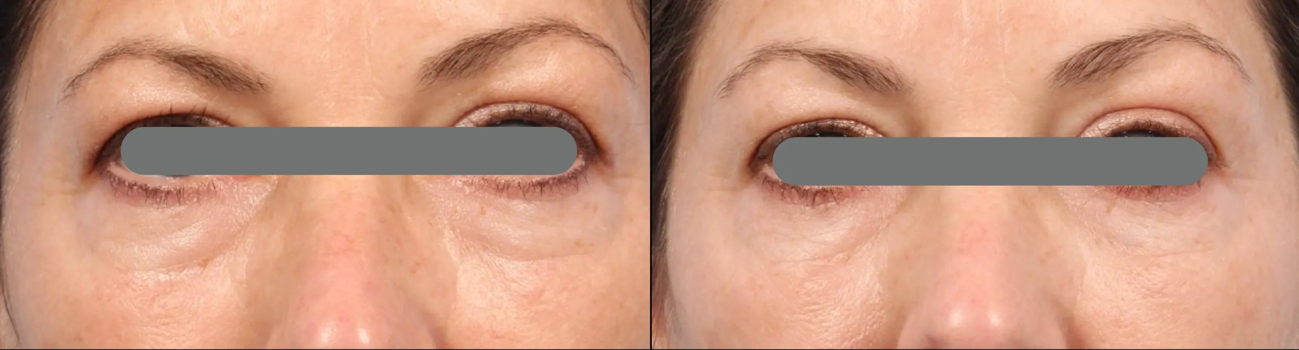 Matrix effect under the eyes