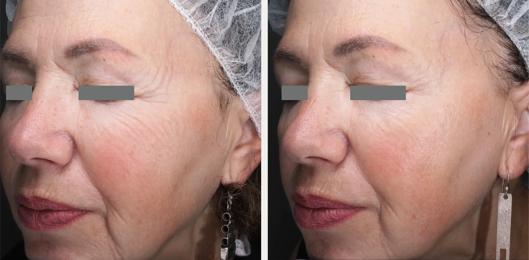 Matrix effect for crow’s feet