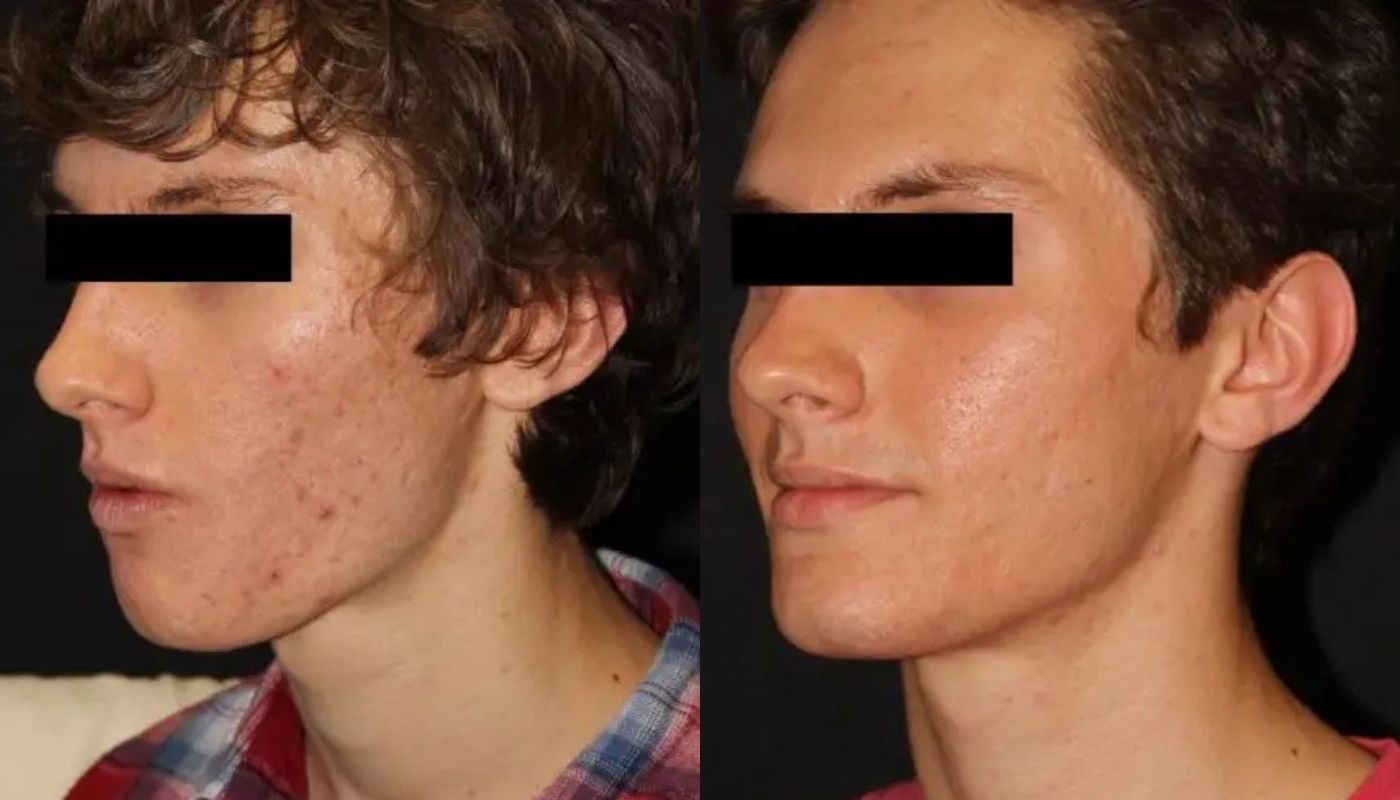 Microneedling before and after