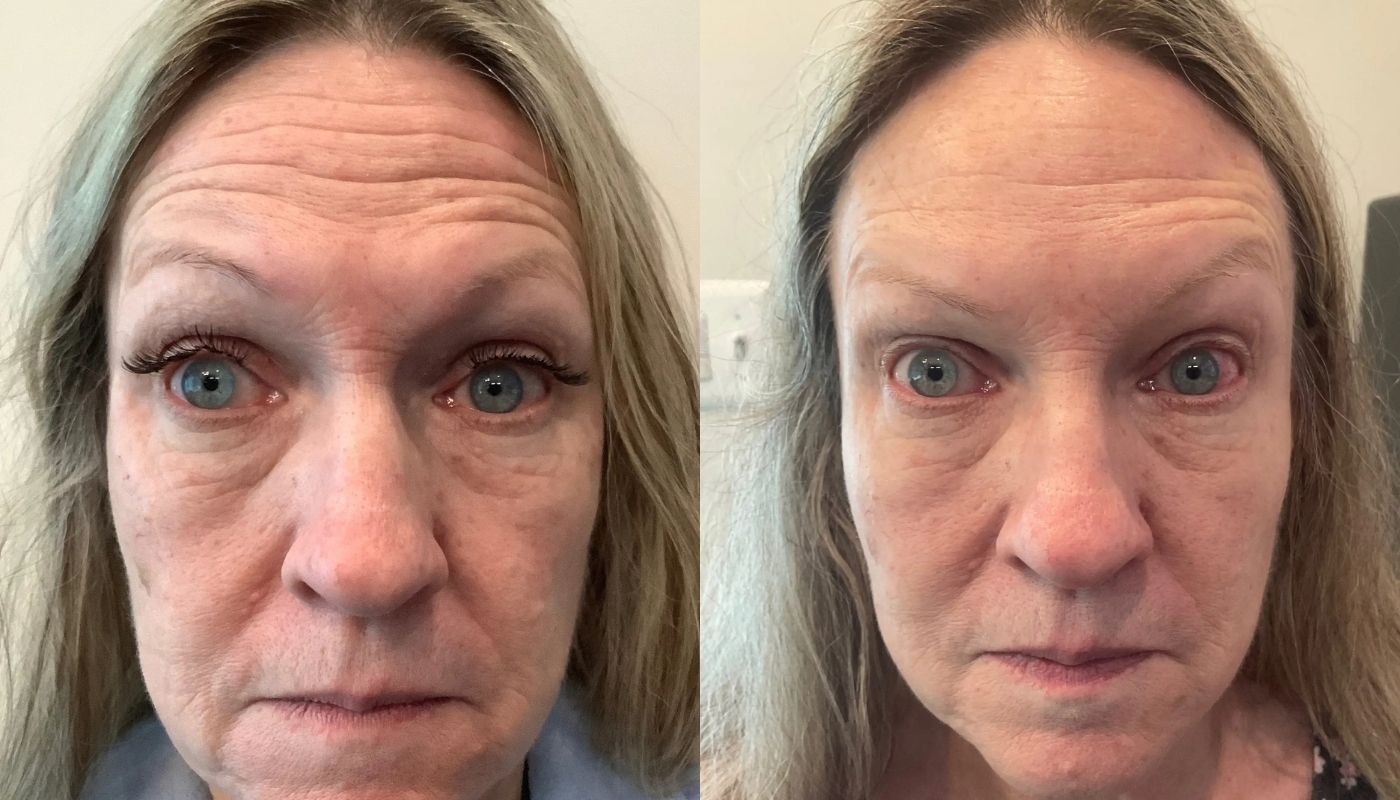 Daxxify before and after
