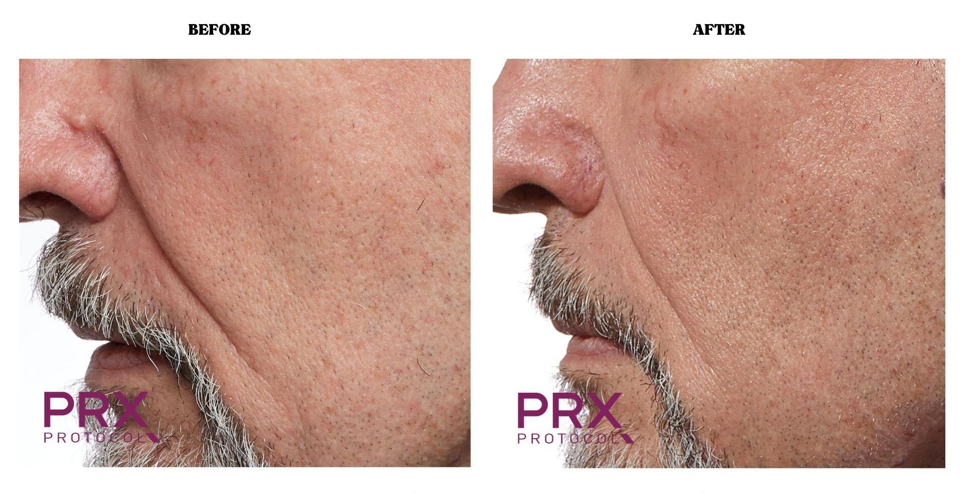 PRX - Before and After