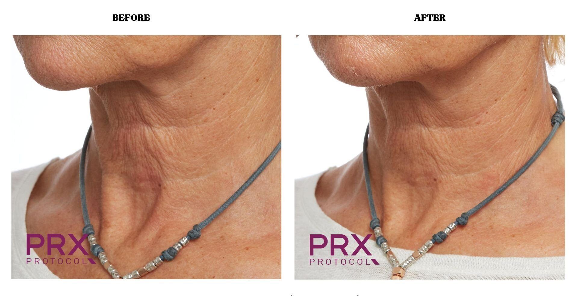 PRX - Before and After
