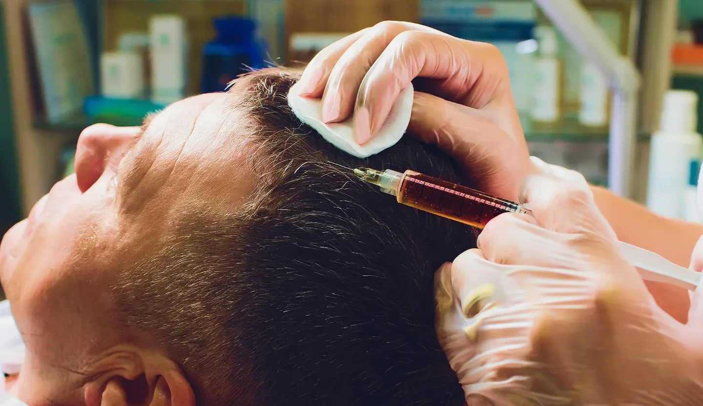 Before and after PRP hair restoration results at DSI Hair