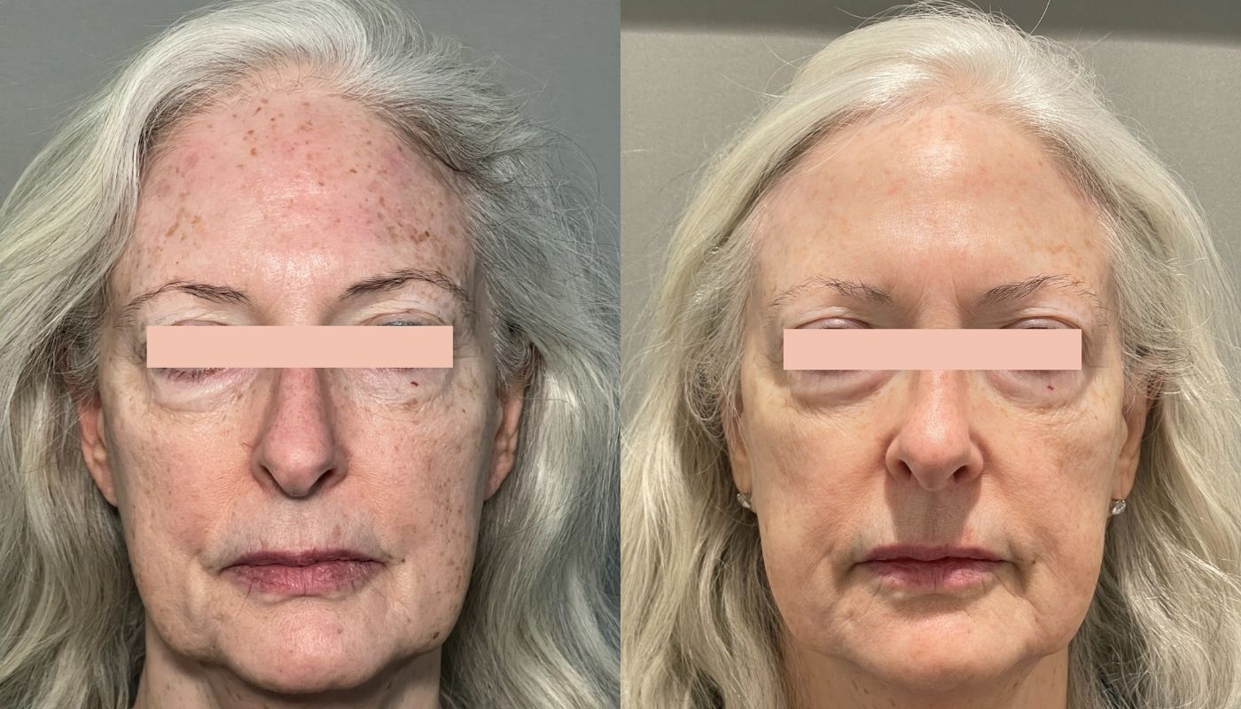 IPL Photo Rejuvenation before and after