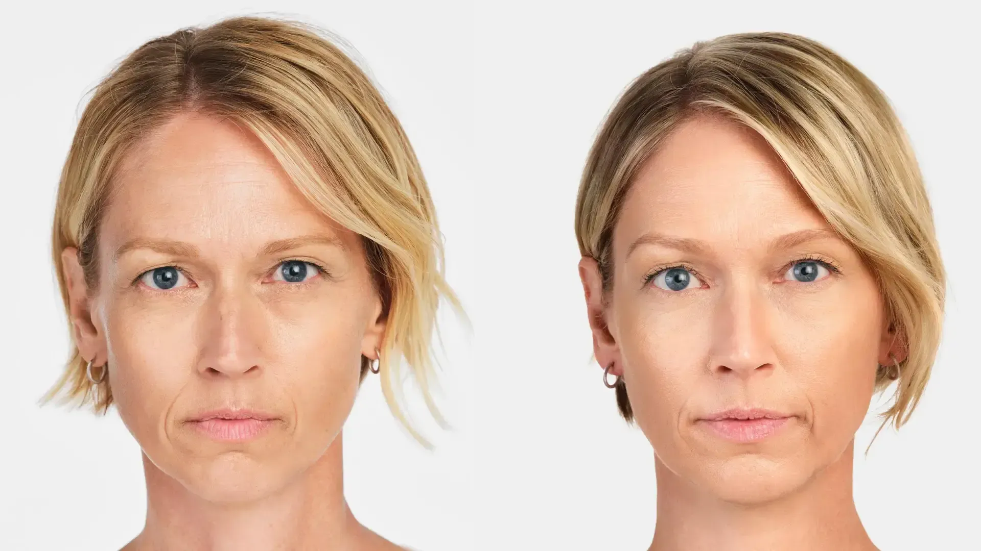 Before and after Radiesse treatment results at Mint Aesthetics & Skin.