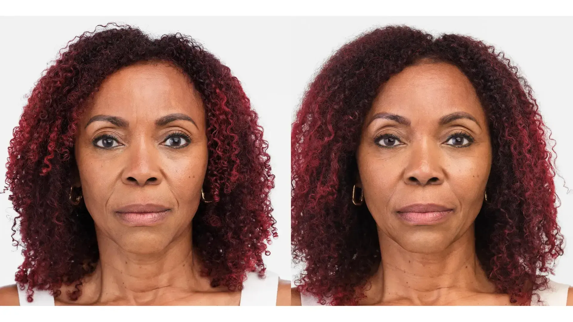 Before and after Radiesse volume restoration results.