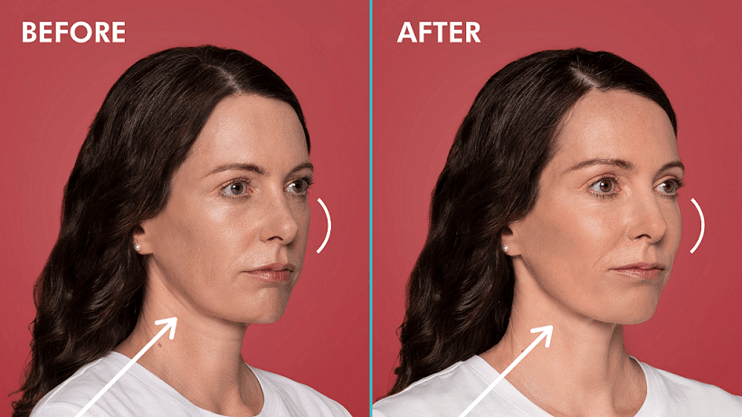 Restylane effect on cheeks