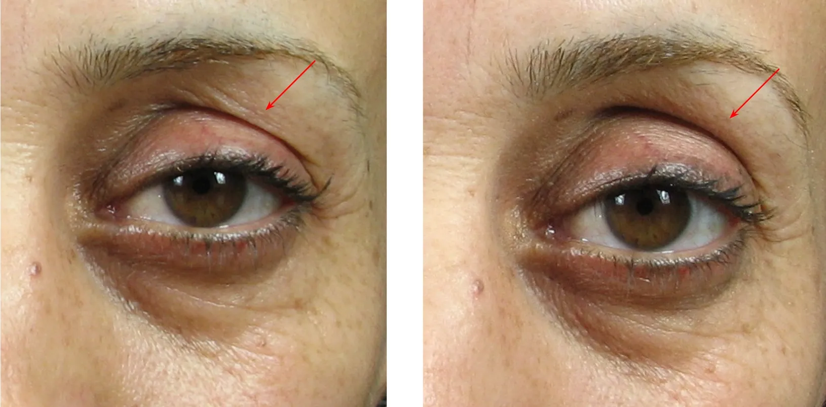 Sublative effect on eyelids