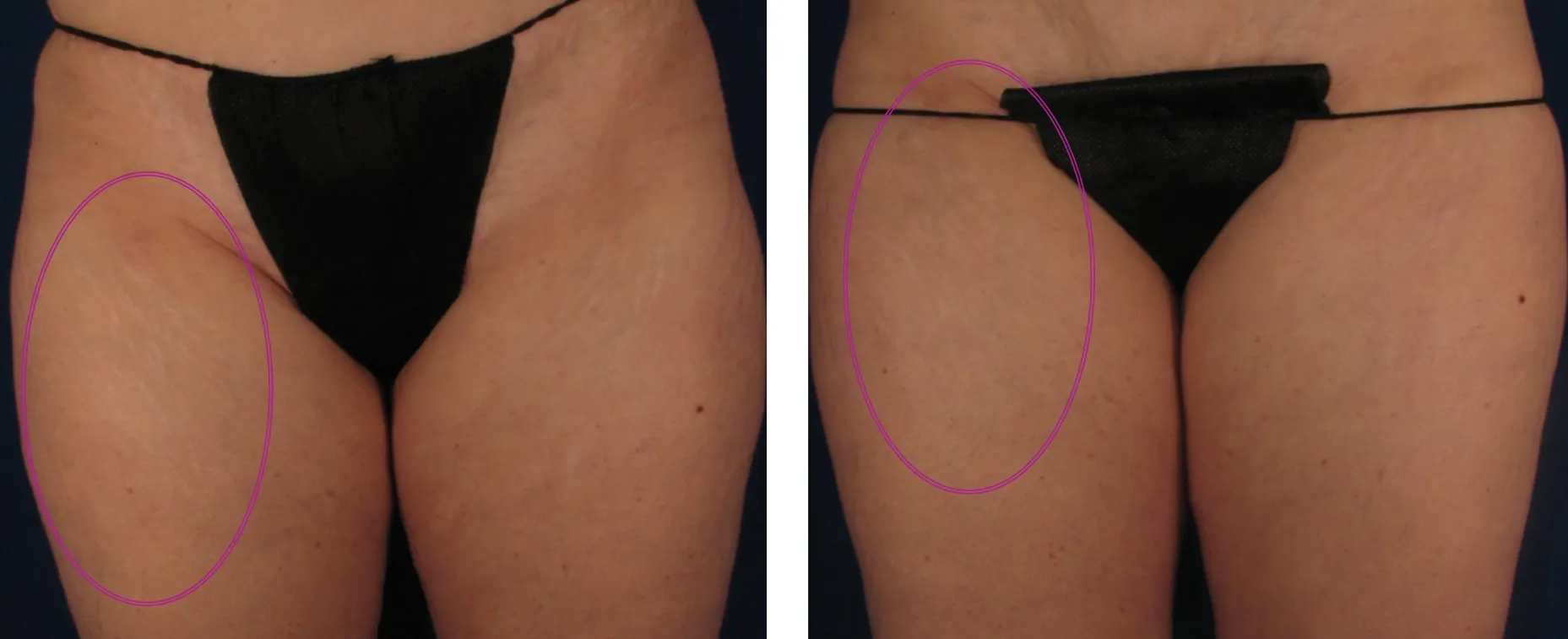 Sublative effect on thighs