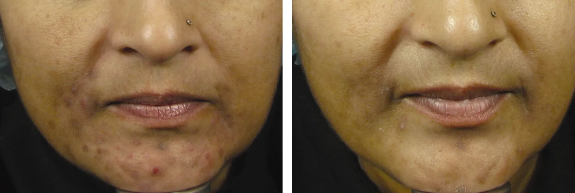 Sublative effect on the chin