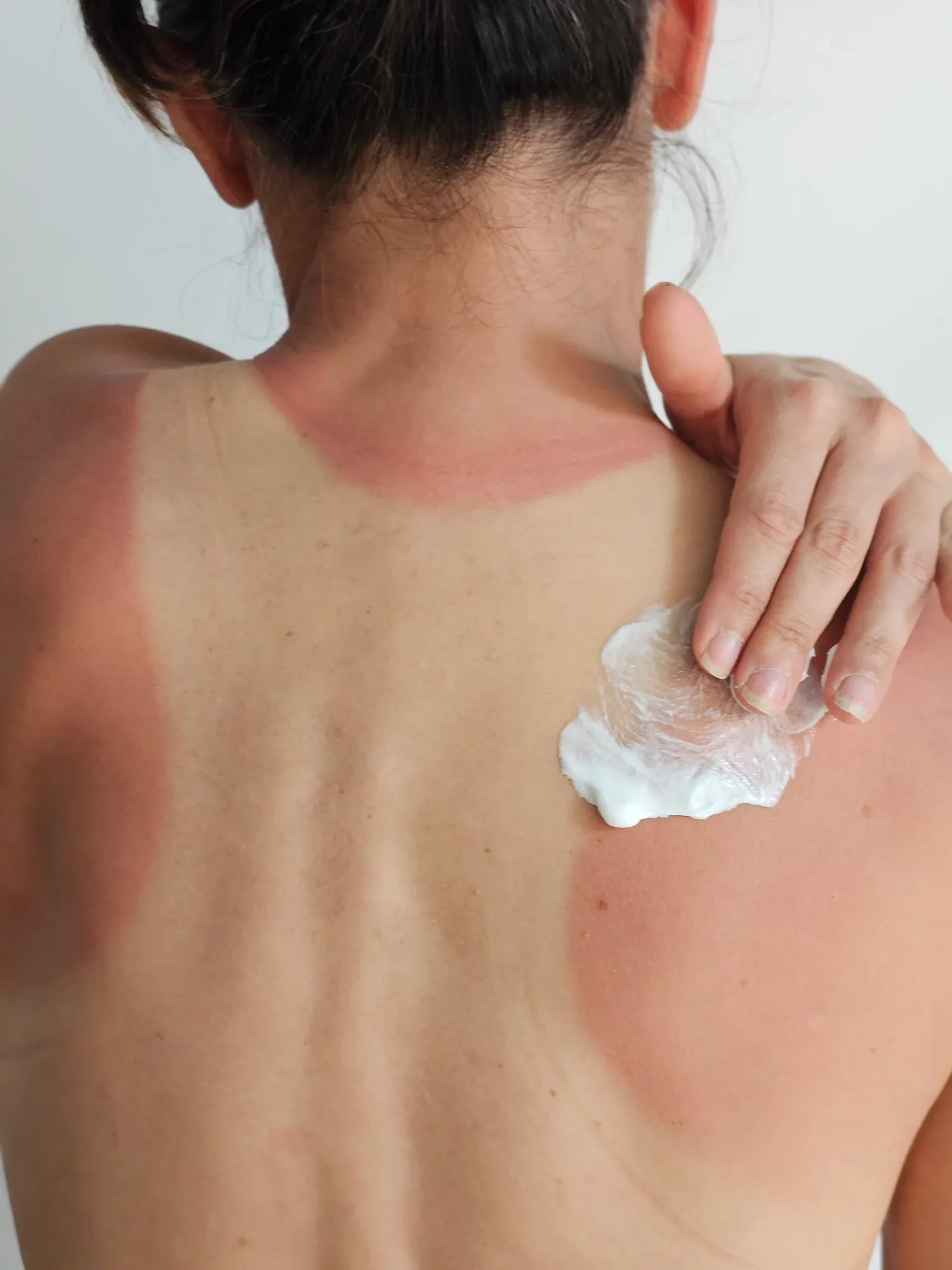 Illustration of UV damage and collagen breakdown at Resurgent Health Fargo