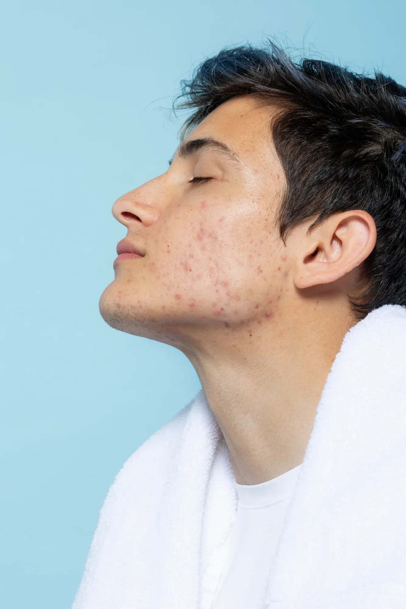 Microneedling device demonstrating collagen induction at Radiant Laser MD Cambridge