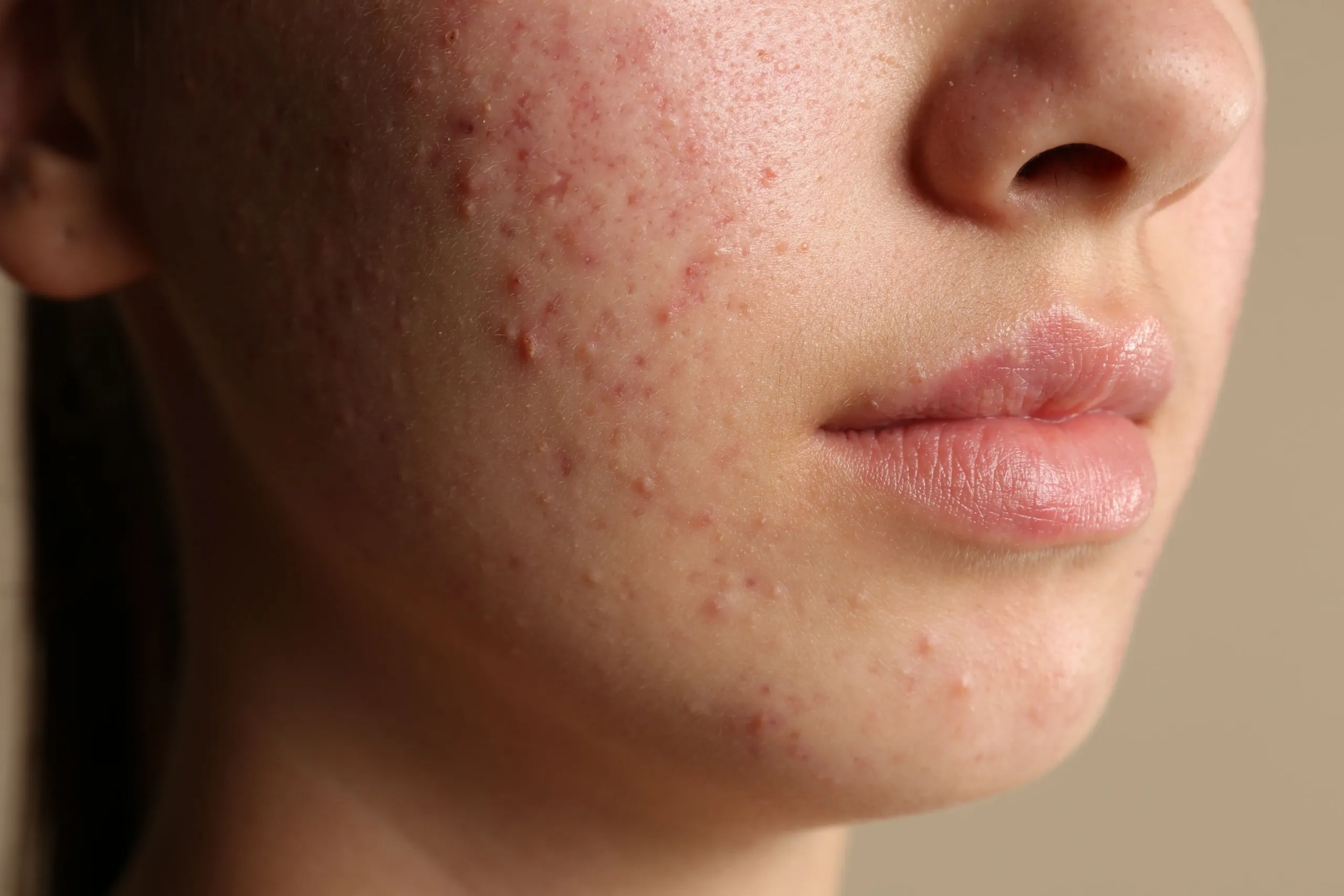 Person with smooth clear skin after laser acne scar treatment at Eternal Wellness Medical Spa in Traverse City MI