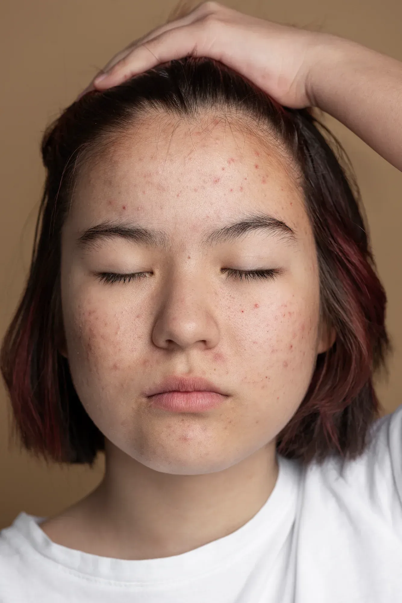 Close-up view of atrophic acne scarring at Resurgent Health Fargo