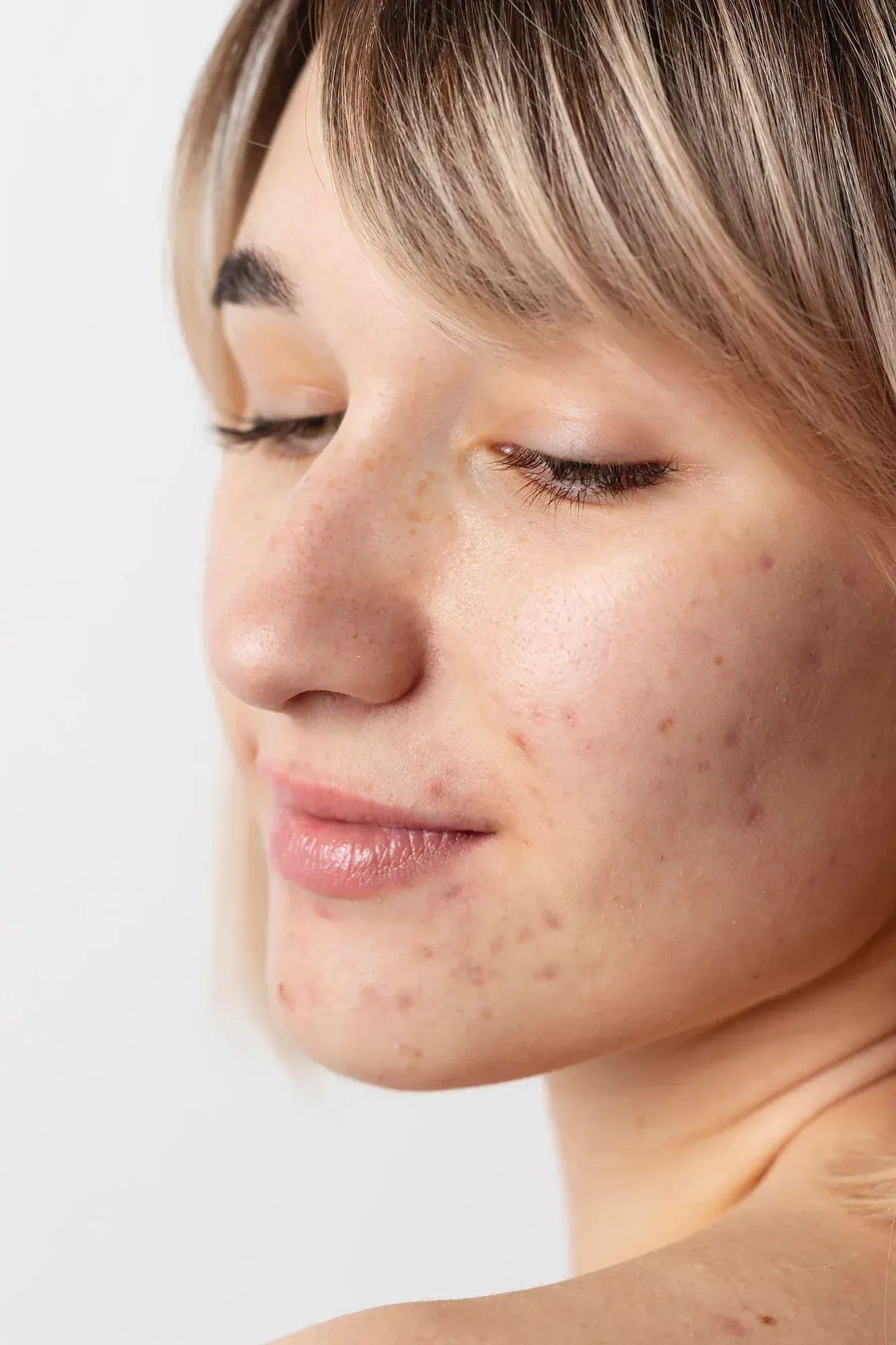 Diagram showing icepick, boxcar, and rolling acne scars at Resurgent Health