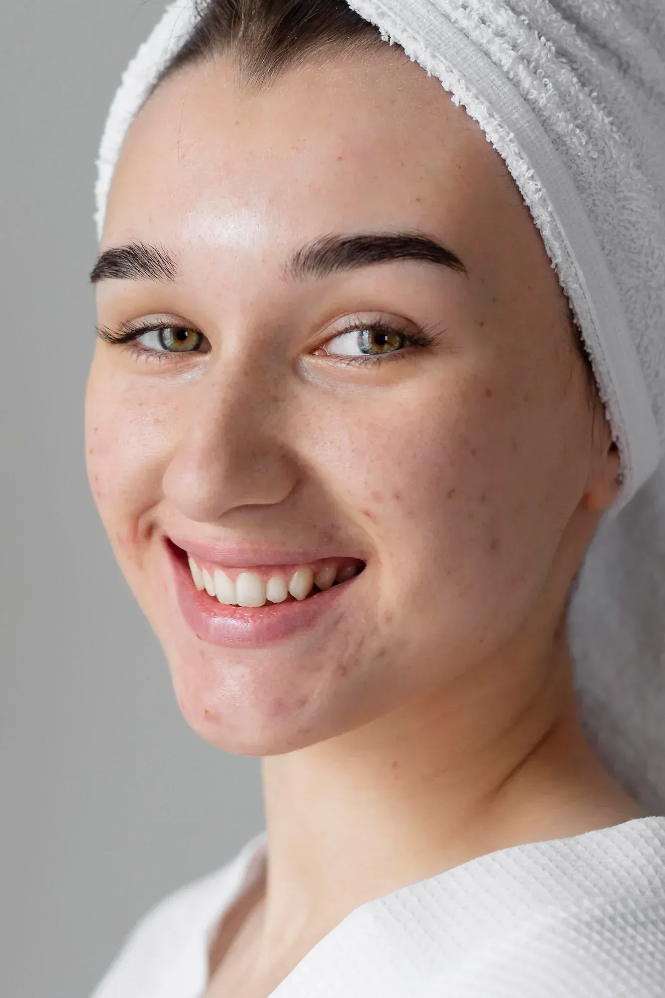 Person concerned about acne scars consulting a provider at Resurgent Health Fargo