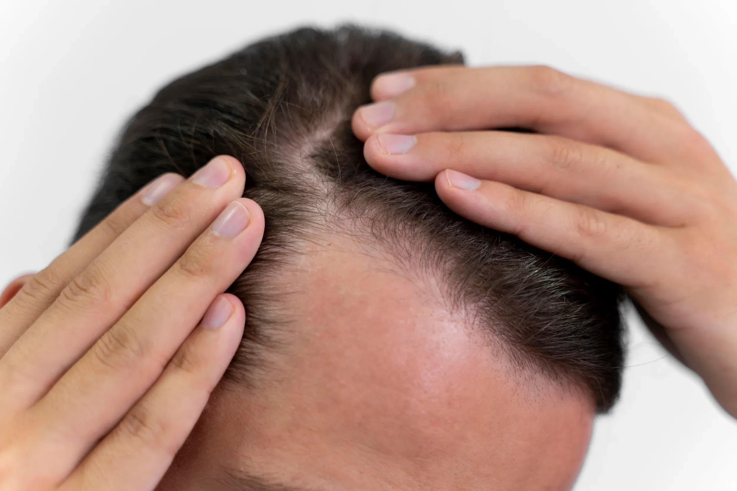 Non-surgical hair loss treatment options at DSI Hair Algonquin