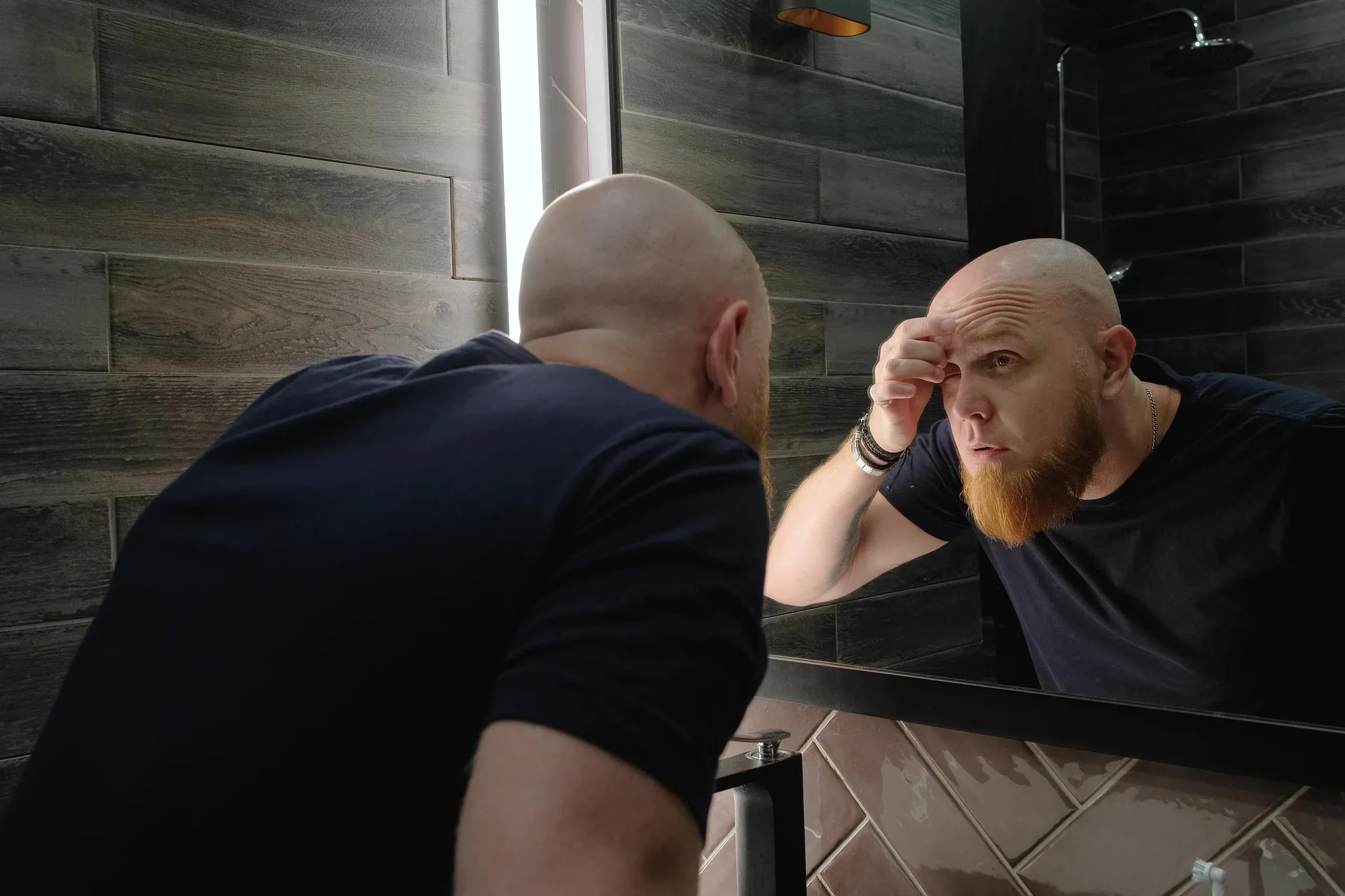 Understanding Alopecia Universalis: Causes, Symptoms, and Treatment