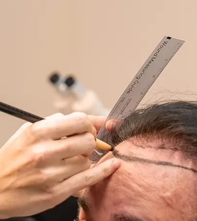 ARTAS robotic hair transplant procedure at DSI Hair