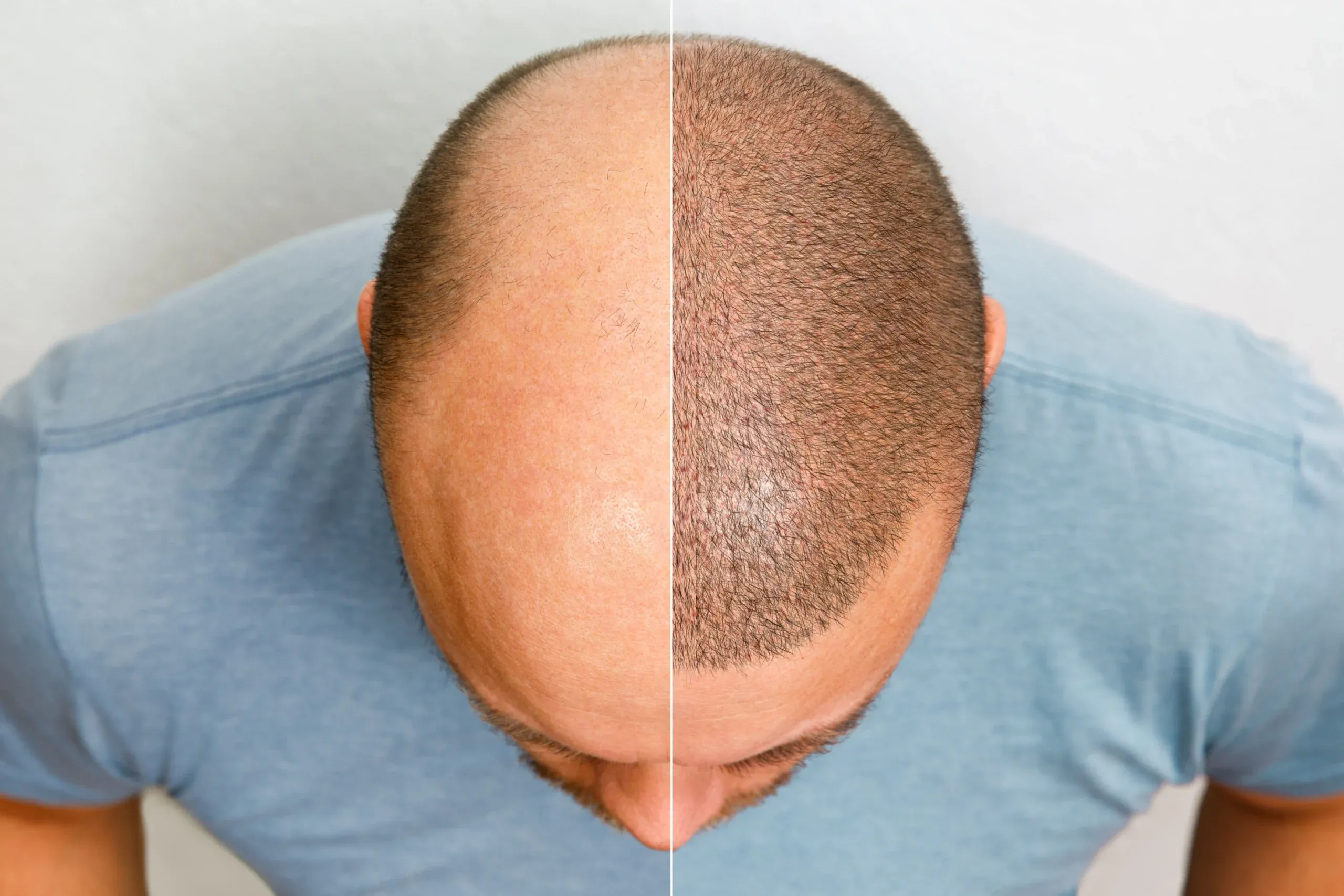 ARTAS Hair Transplant Recovery: Timeline and What to Expect