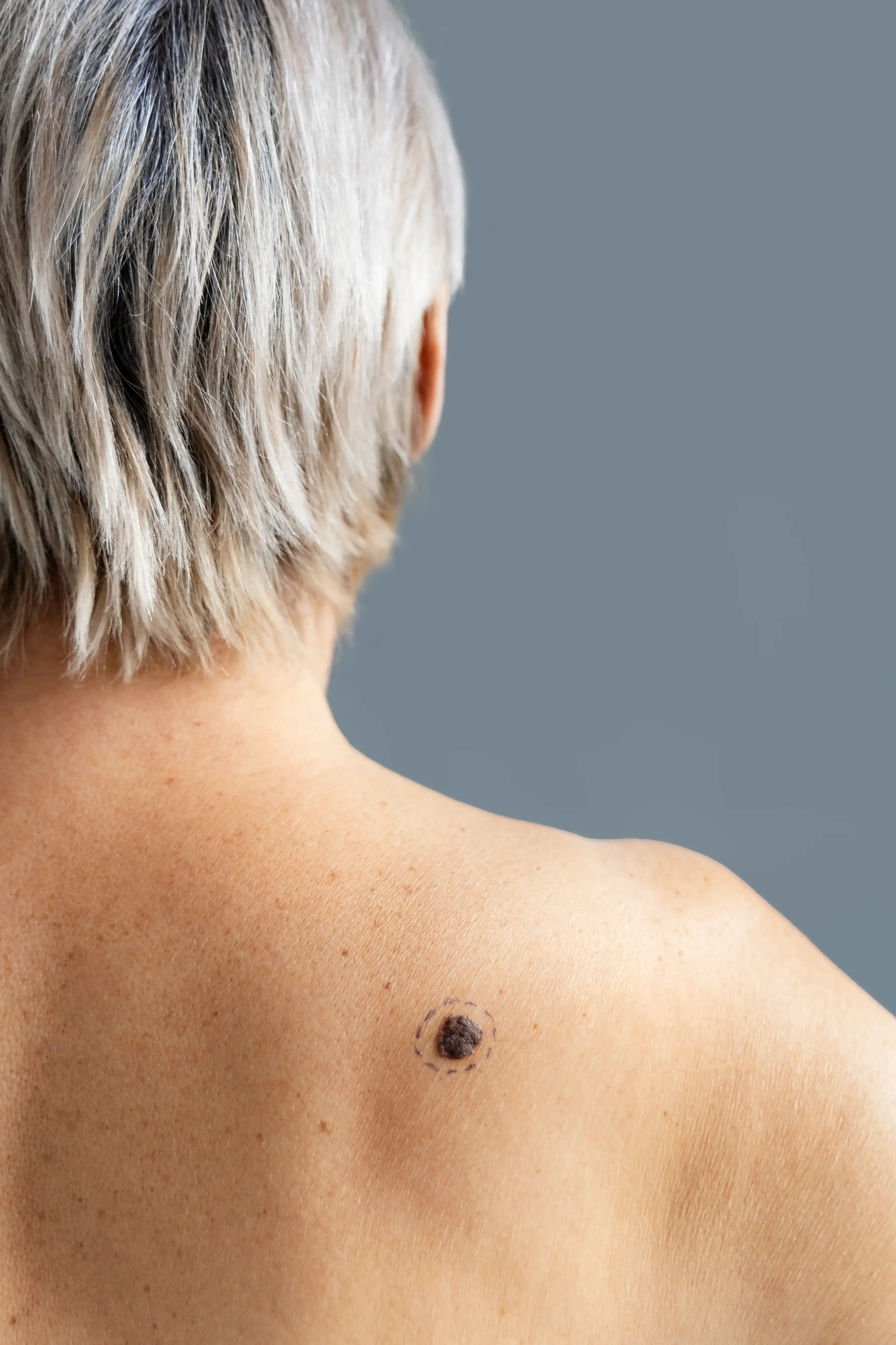 physician reviewing wart removal aftercare with patient Venice FL