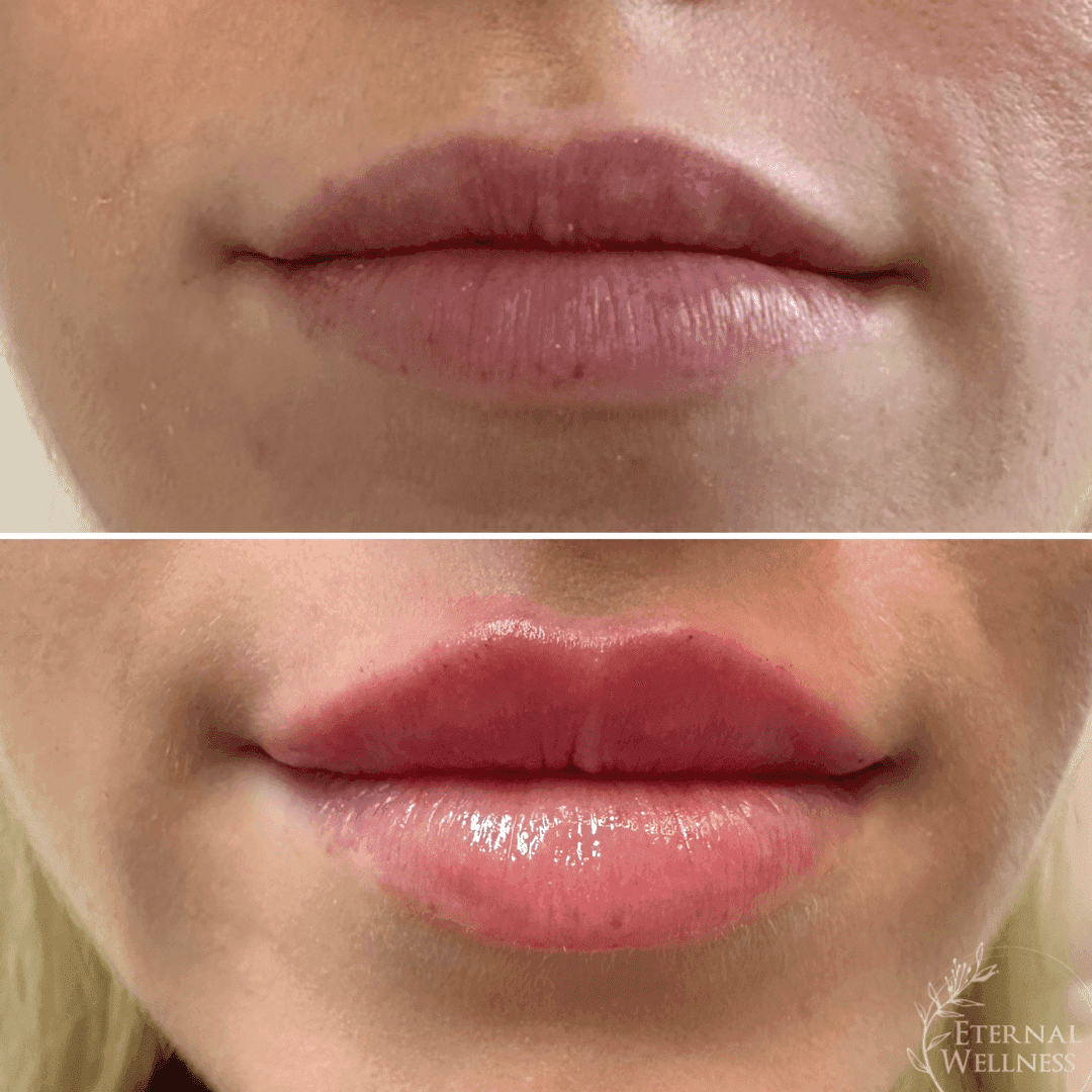 Lip Injections before and after