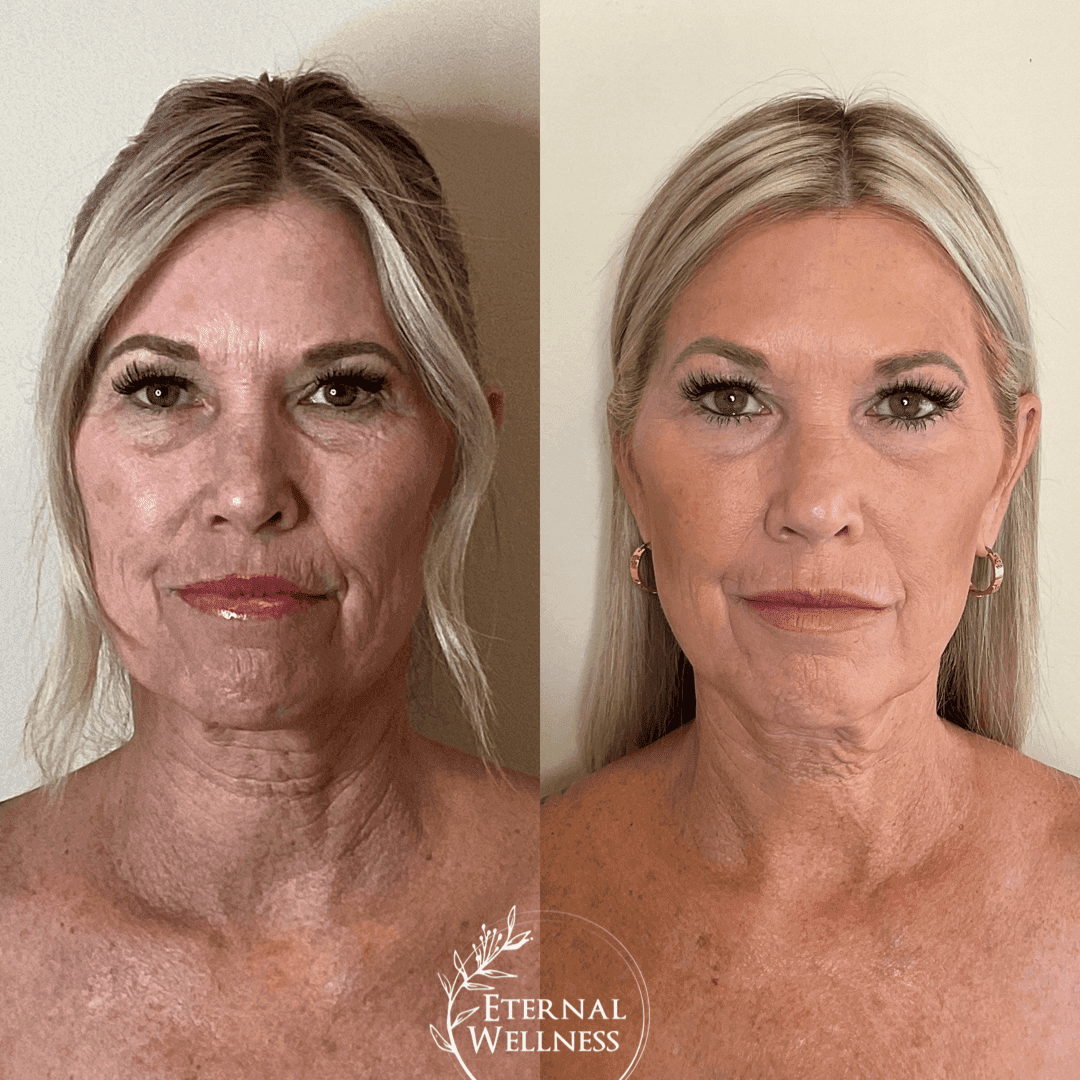 Morpheus8 Face before and after