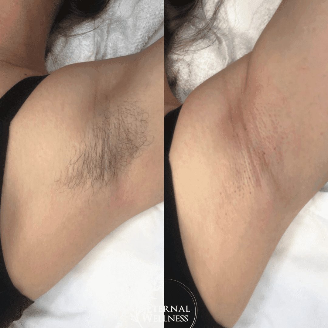 DiolazeXL Laser Hair Removal before and after