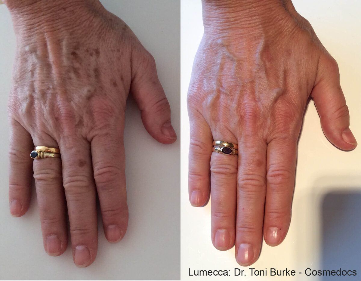 Lumecca IPL Body before and after
