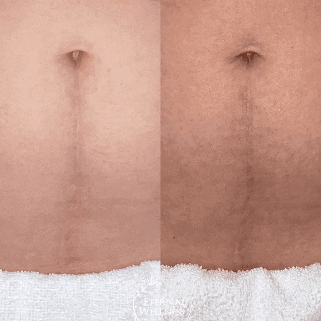 Morpheus8 Body before and after