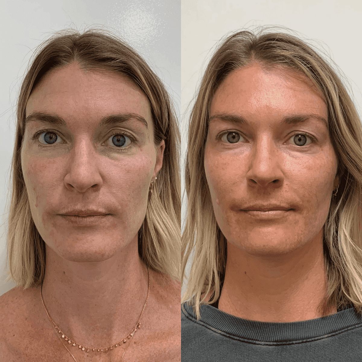 PRP & PRF before and after